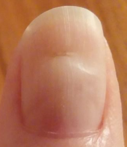 Nail Fungus Photo - After Rest Easy Probiotics
